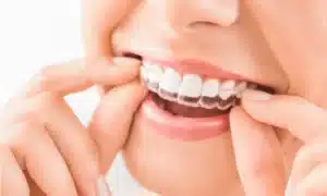 Clear dental aligner being placed over the front teeth